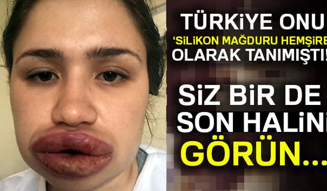 Silikon mağduru hemşire Merve Keleşin dudakları Adanada bir doktor tarafından uygulanan tedavi yöntemiyle eski haline döndü