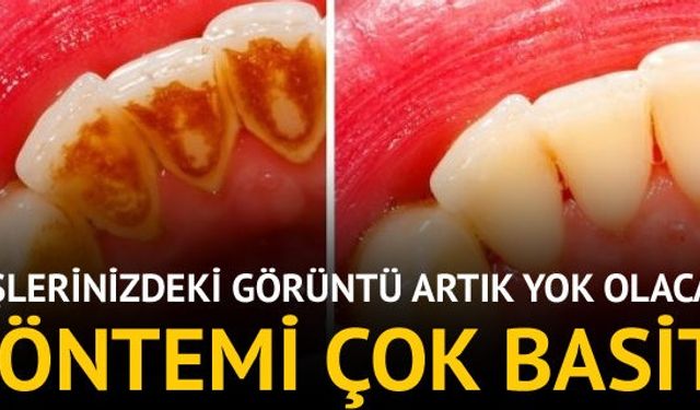 Sağlıklı, beyaz, plaktan ve tartardan arınmış dişler, çoğumuzun hayali ve güzel görünmenin olmazsa olmazlarından biridir