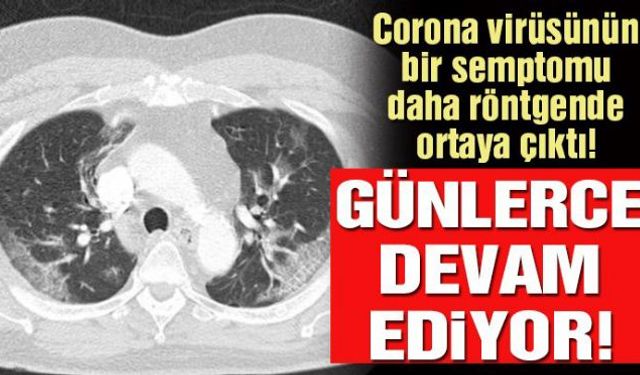 Corona virüsü salgınında vaka sayısı 19